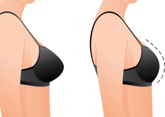 Breast Reduction: Everything You Need to Know and More