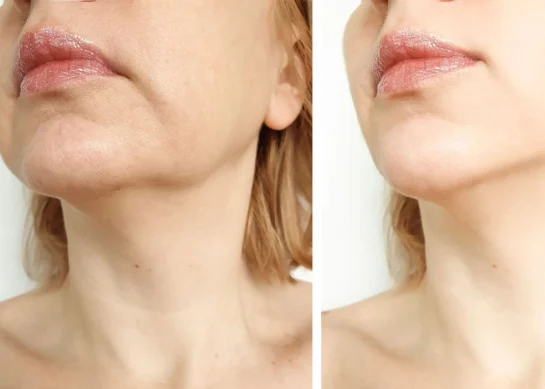 Facelift: Everything You Need to Know and More