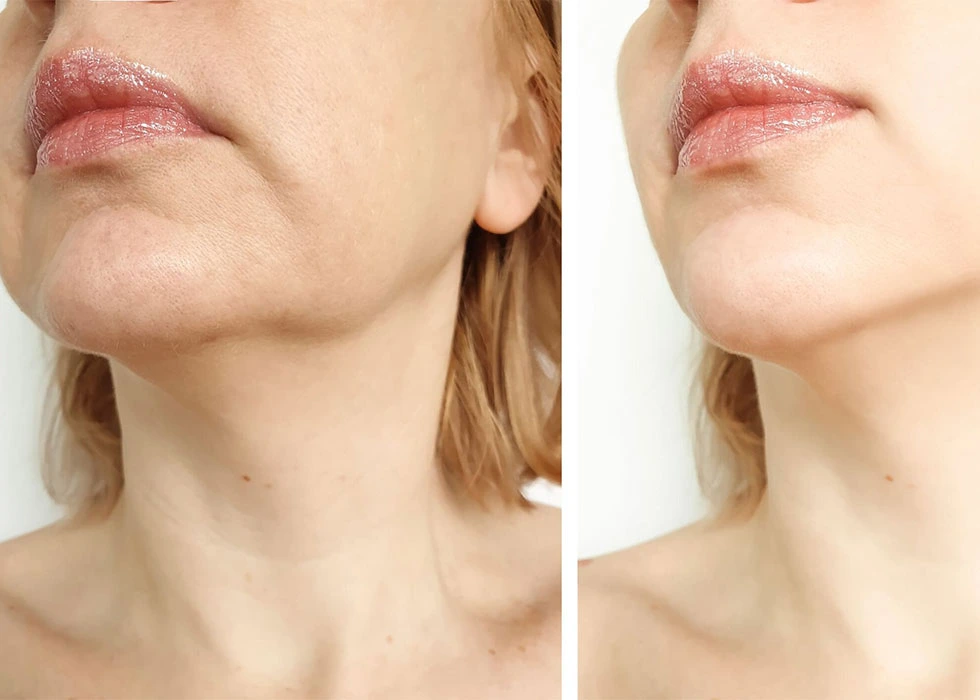 Facelift: Everything You Need to Know and More