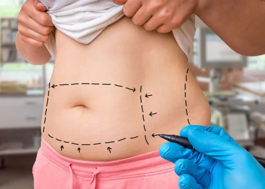 Swelling after liposuction: Reason and Solution