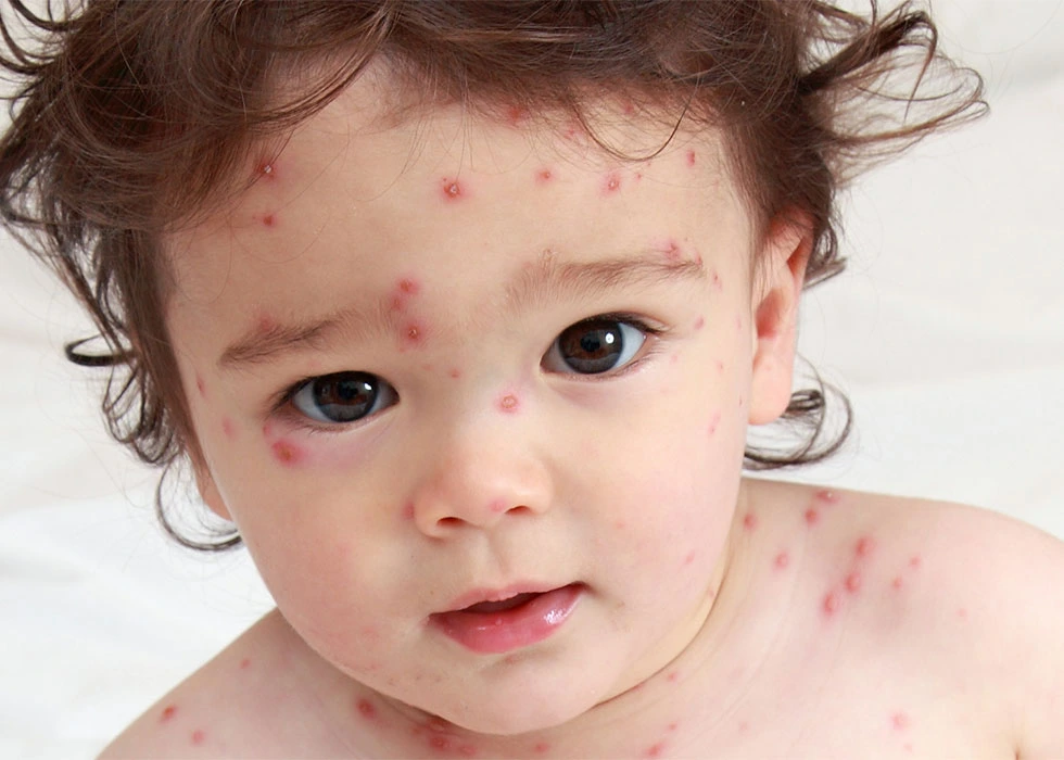Chickenpox (Varicella): Symptoms, Causes, Complications & Prevention