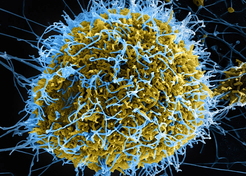 Ebola Virus Disease (EVD): Symptoms, Transmission, Treatment & Prevention