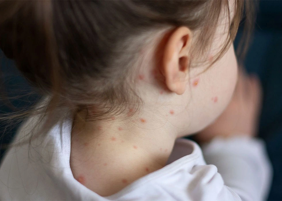 Measles: Symptoms, Risks, Treatment, and Prevention