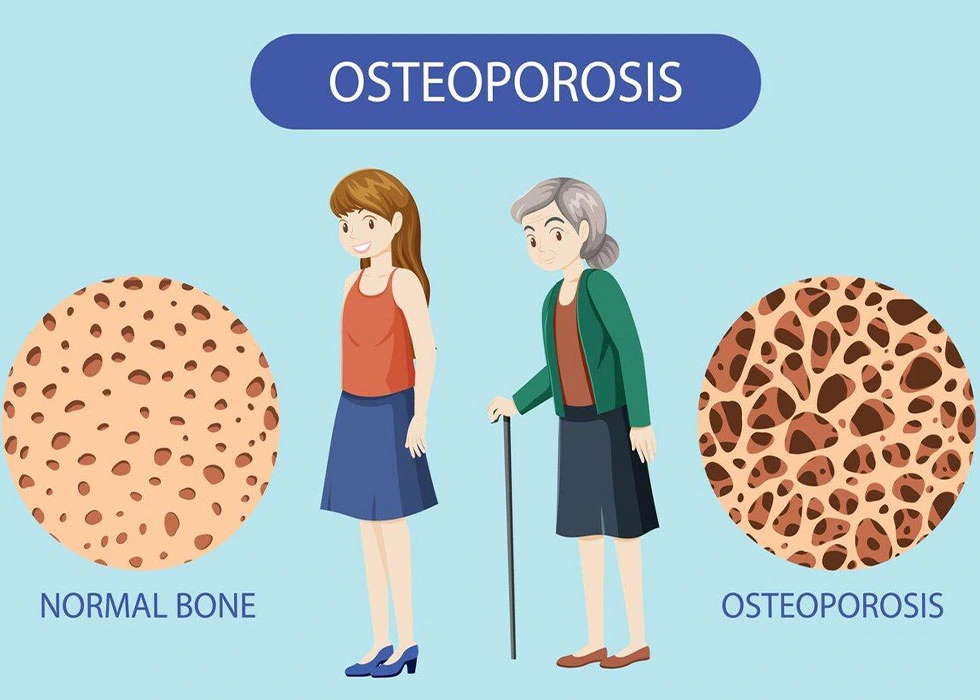Osteoporosis: Causes, Symptoms, Risk Factors, and Prevention