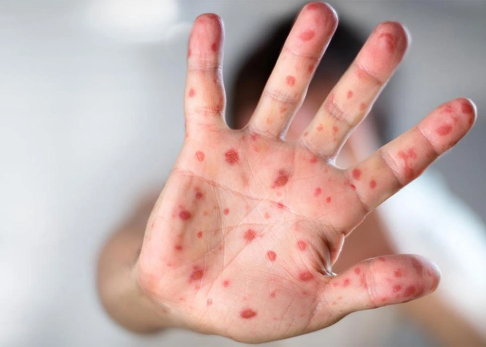 Rubella (German Measles): Symptoms, Risks, CRS & Prevention