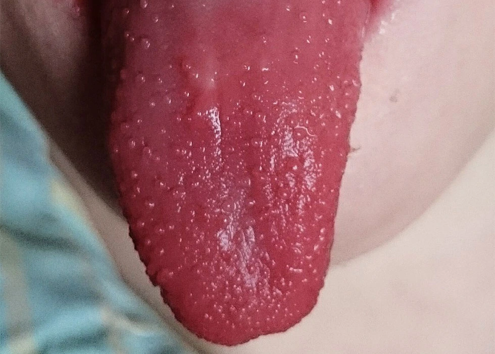 Scarlet Fever: Symptoms, Causes, Treatment & Prevention Guide