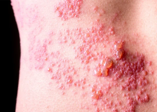 Shingles (Herpes Zoster): Causes, Symptoms, Treatment, and Prevention