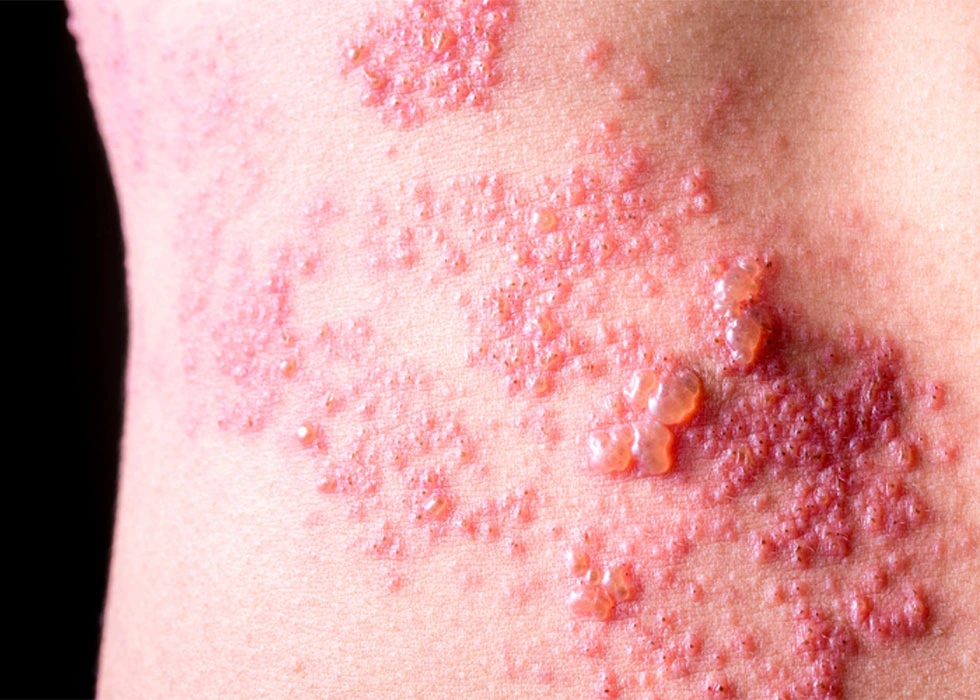Shingles (Herpes Zoster): Causes, Symptoms, Treatment, and Prevention