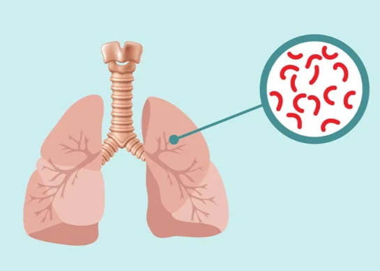 Tuberculosis (TB): Symptoms, Causes, Treatment & Prevention