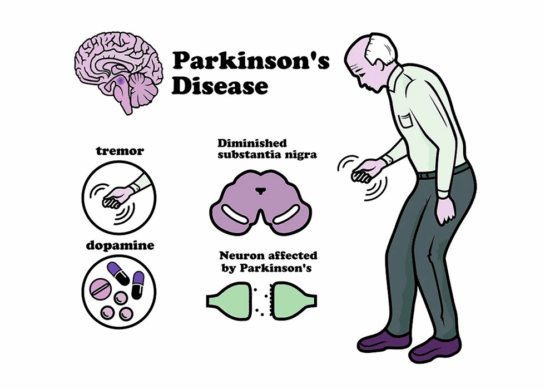 Parkinson’s Disease: Symptoms, Causes, Treatment, and Living Well